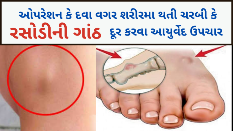 રસોળી નો ઈલાજ